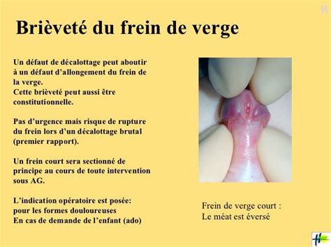 déchirure frein|RUPTURE DU FREIN DE LA VERGE